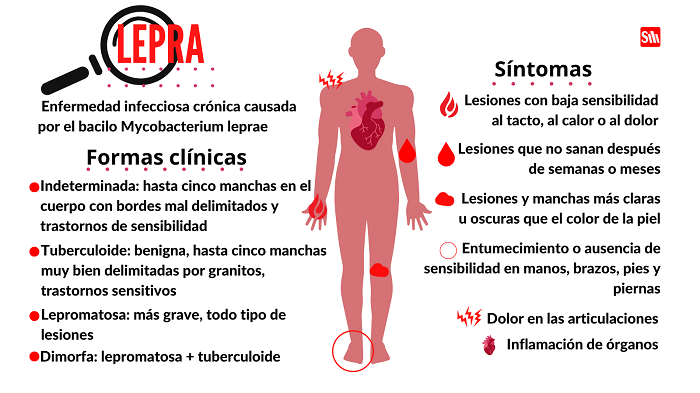 Lepra: tratable y curable 2 lepra1