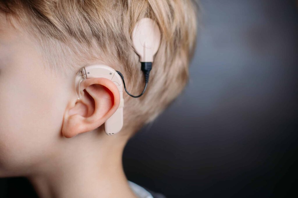 Implantes cocleares benefician en Cuba a niños con discapacidad auditiva
